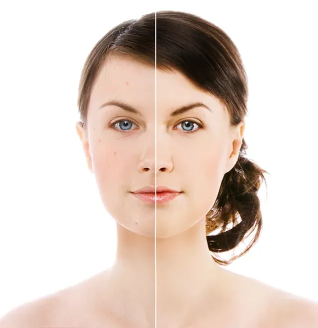 Hydrafacial image